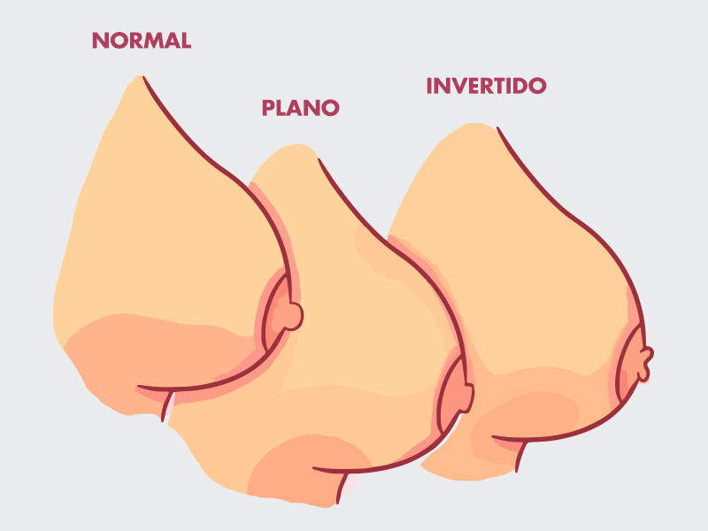 Ilustração de mamilos planos, invertidos e normal