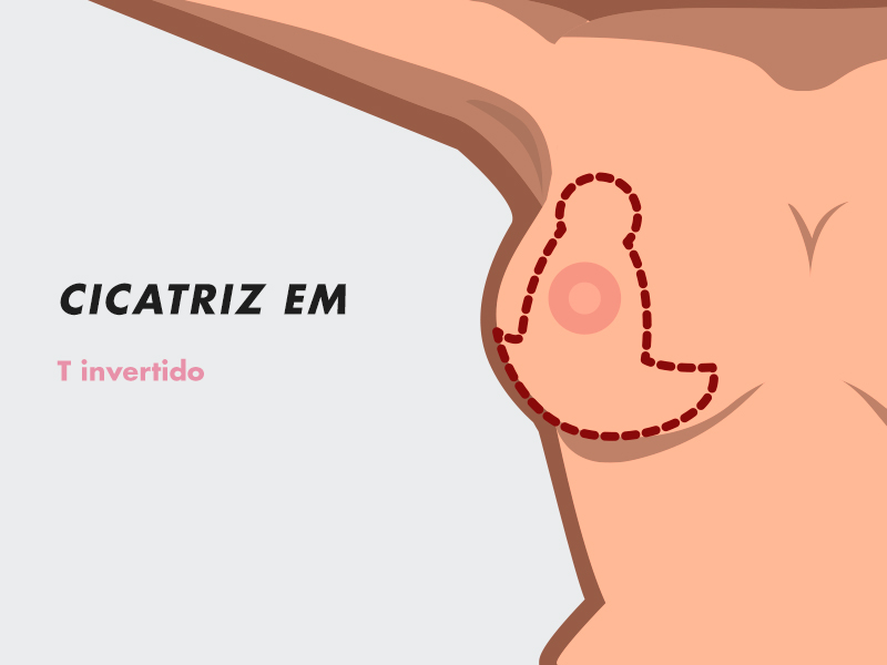Cicatriz da cirurgia de gigantomastia gigantomastia cicatriz