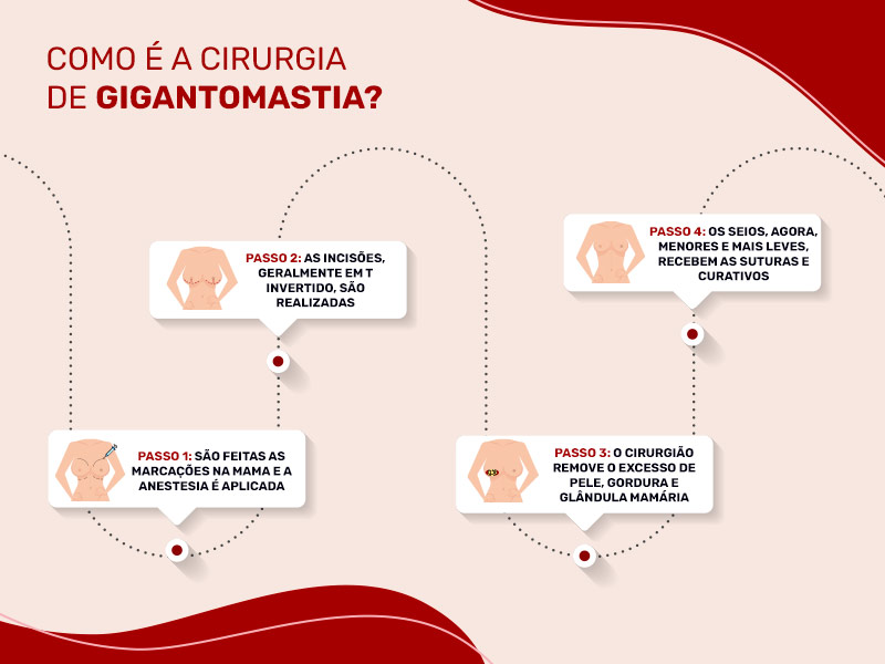 Ilustração que mostra o passo a passo da cirurgia de gigantomastia