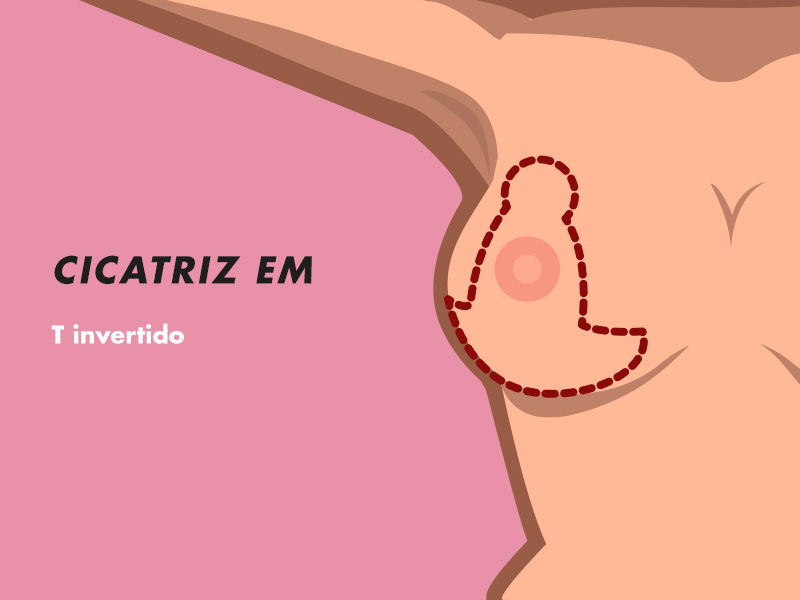 Cicatriz da redução de mama cirurgia diminuir peito cicatriz