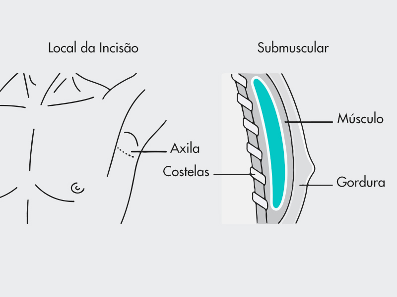 ilustração mostrando a localização da incisão da cirurgia de silicone masculino