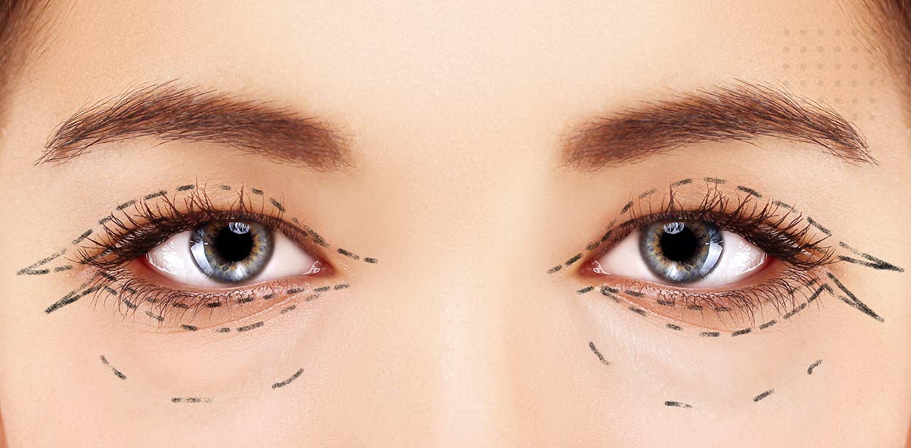 Cantopexia: Veja a cirurgia para aumentar olhos | Dream Plastic