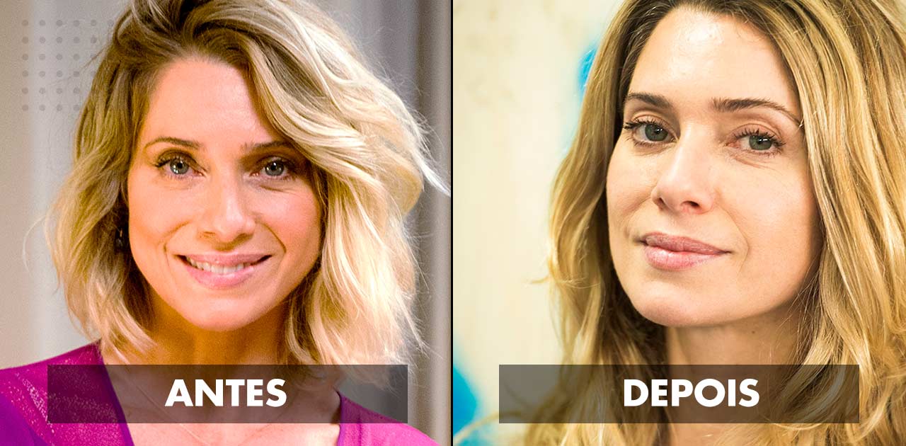 Blefaroplastia antes e depois: veja resultados | Dream Plastic