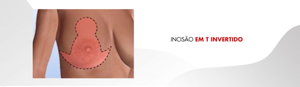 Cicatriz Mastopexia T invertida