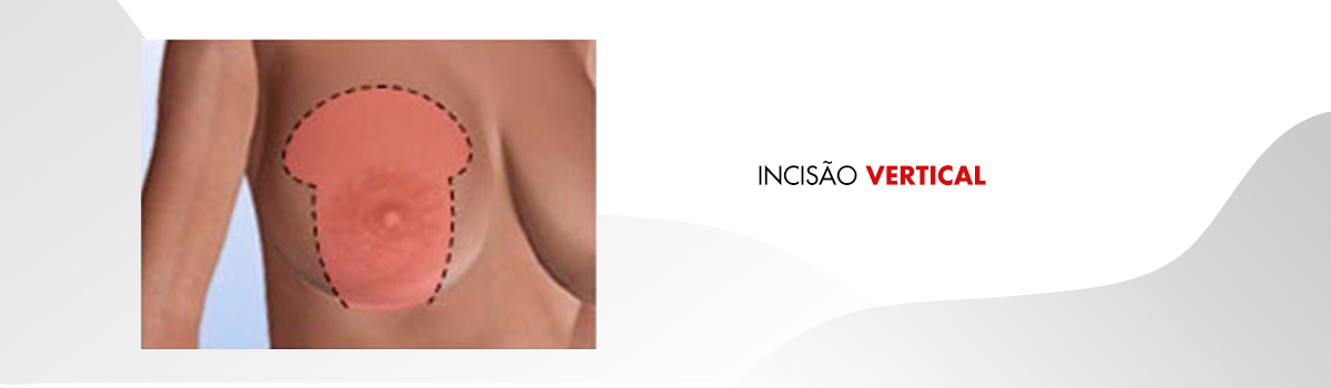 cicatriz mamoplastia redutora