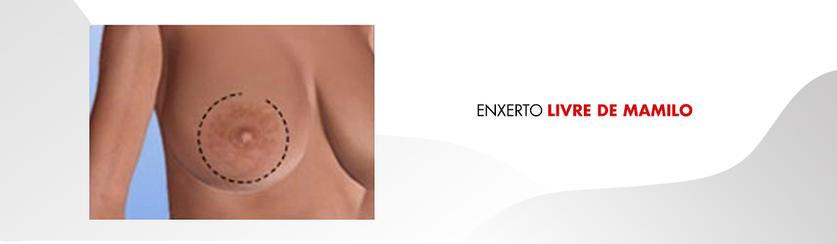 cicatriz Periareolar mamoplastia