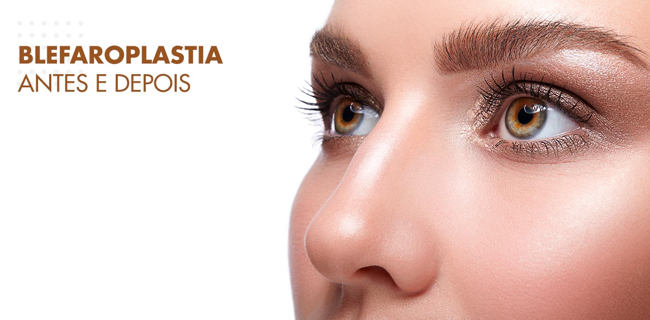 Blefaroplastia antes e depois: veja resultados | Dream Plastic
