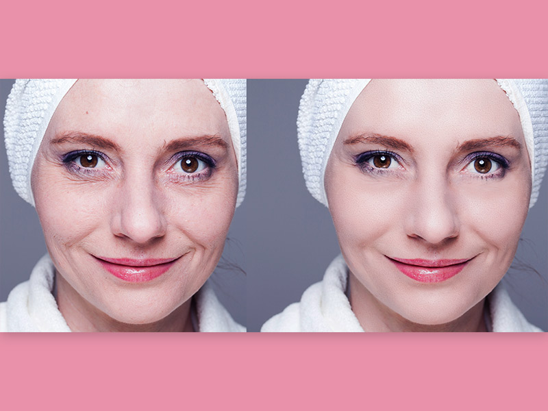 Antes e depois da bioplastia em uma mulher