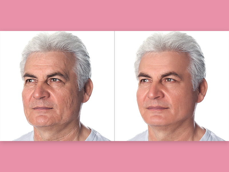Antes e depois da bioplastia masculina