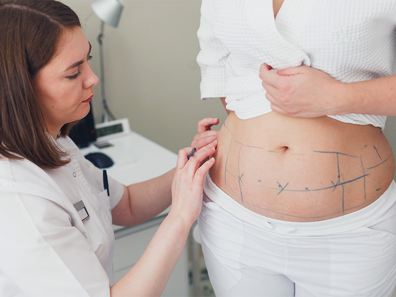 Médica fazendo as marcações em uma paciente para a bioplastia na barriga