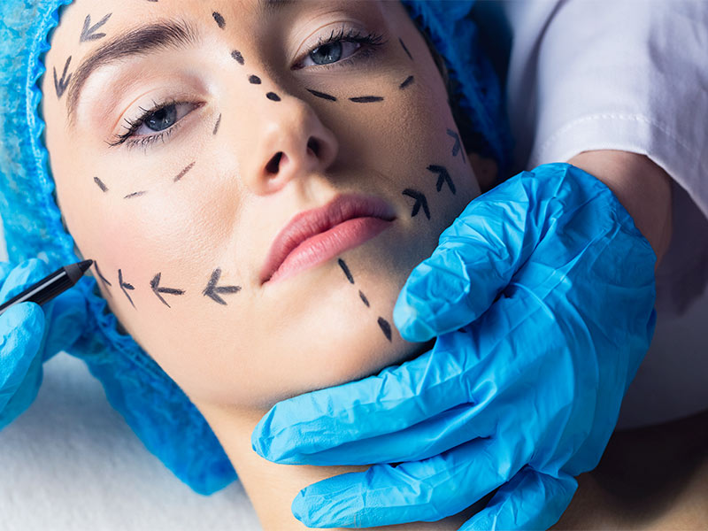 Mulher com as marcações no rosto para a bioplastia