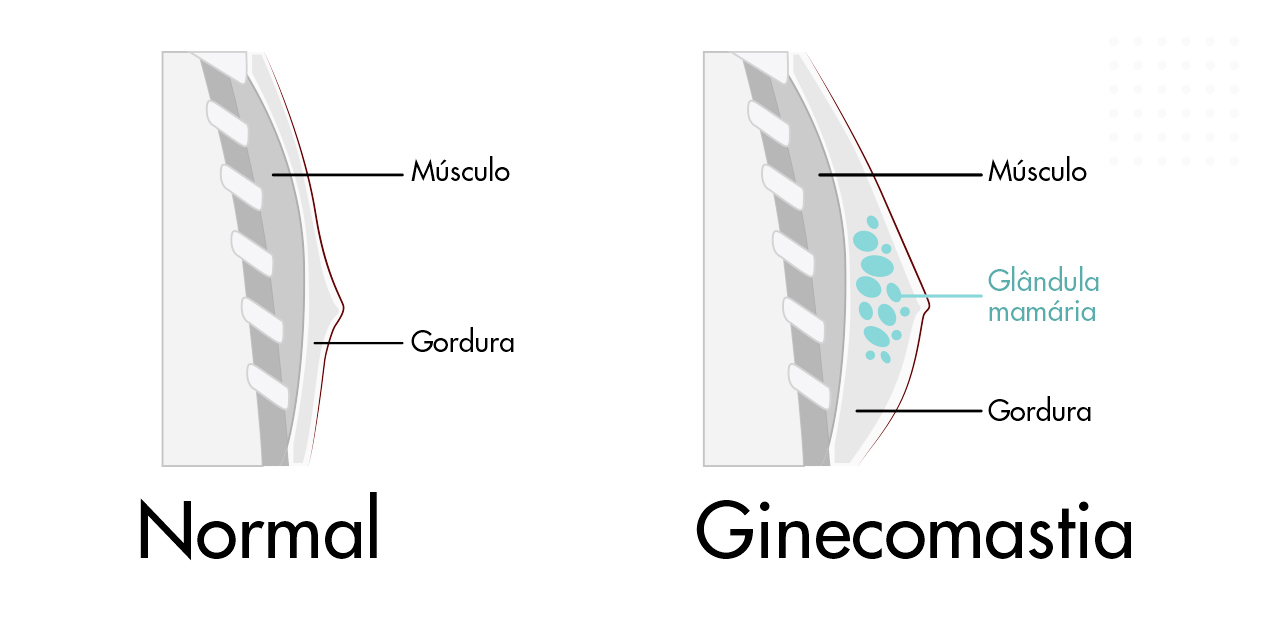 Ginecomastia: Cirurgia para mama masculina| Dream Plastic