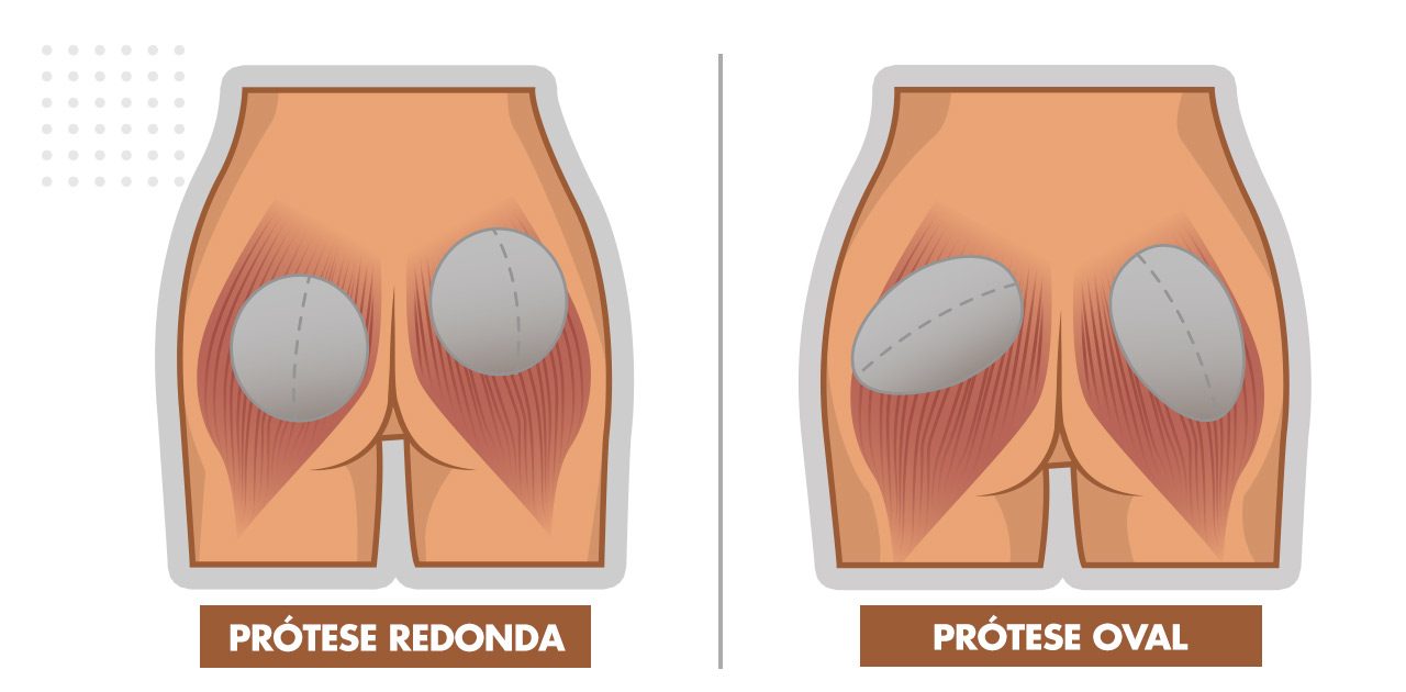 Prótese de Glúteo Oval ou Redonda Prótese de Glúteo Oval ou Redonda