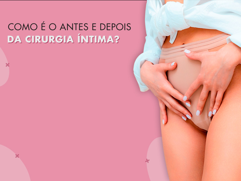 Cirurgia Íntima feminina antes e depois: Veja os resultados das famosas e dicas de quem já operou! cirurgia intima feminina antes depois