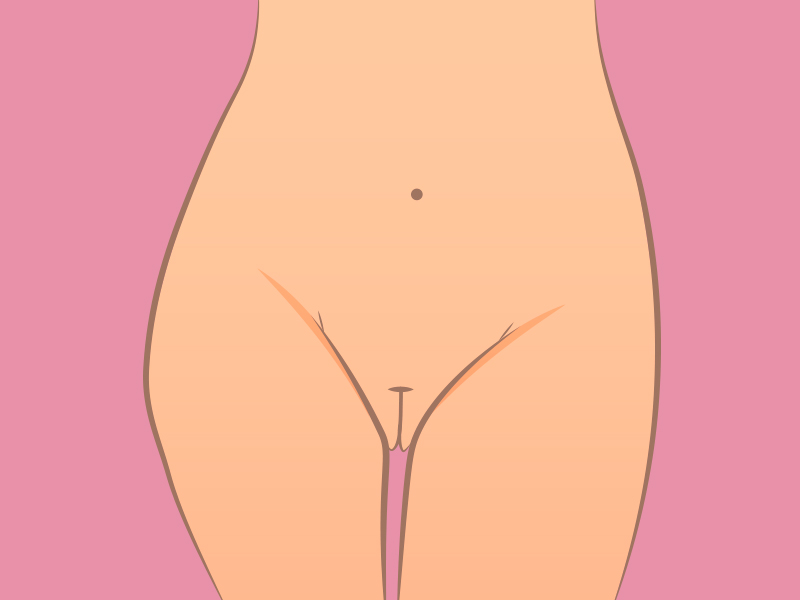 Corrigir flacidez nos grandes lábios grandes labios murchos