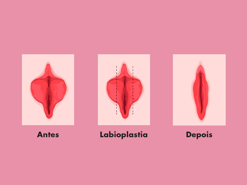 Como é feita a labioplastia para lábios vaginais grandes? cirurgia labioplastia