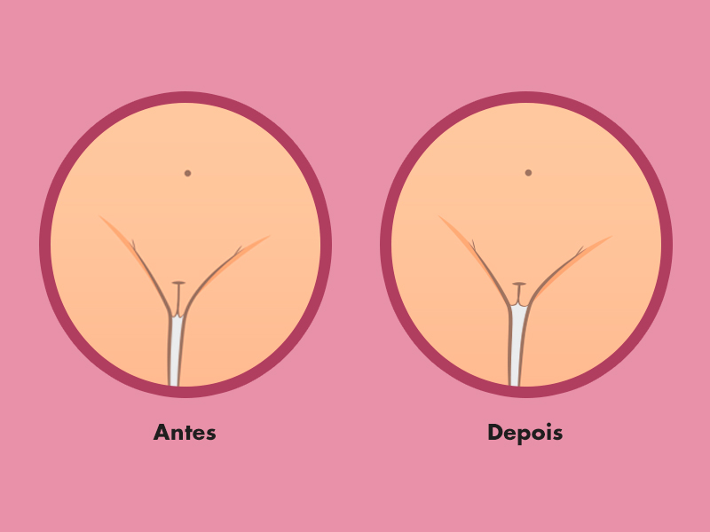 antes depois cirurgia intima