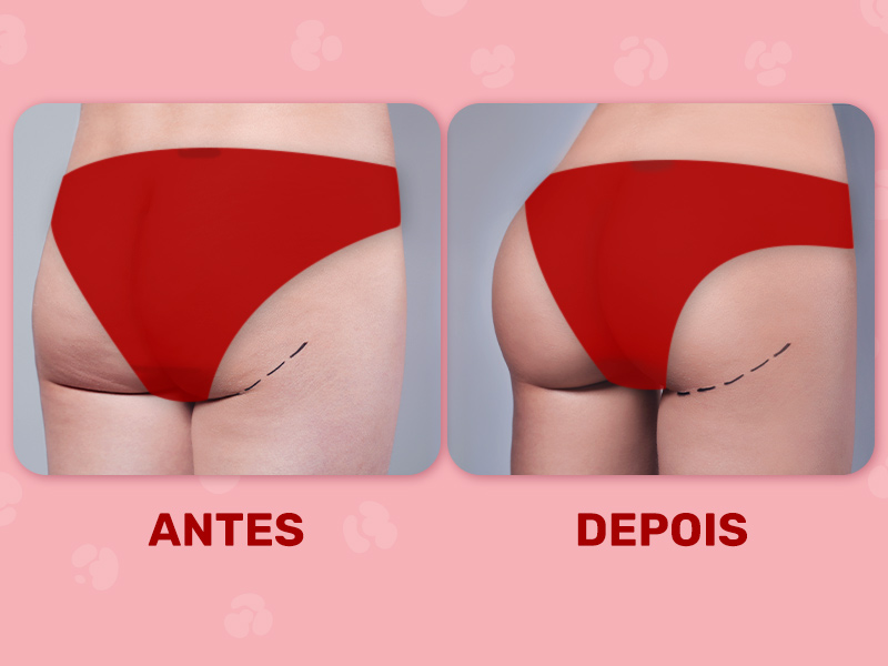 Hip Dips Preenchimento Resultado Antes e Depois