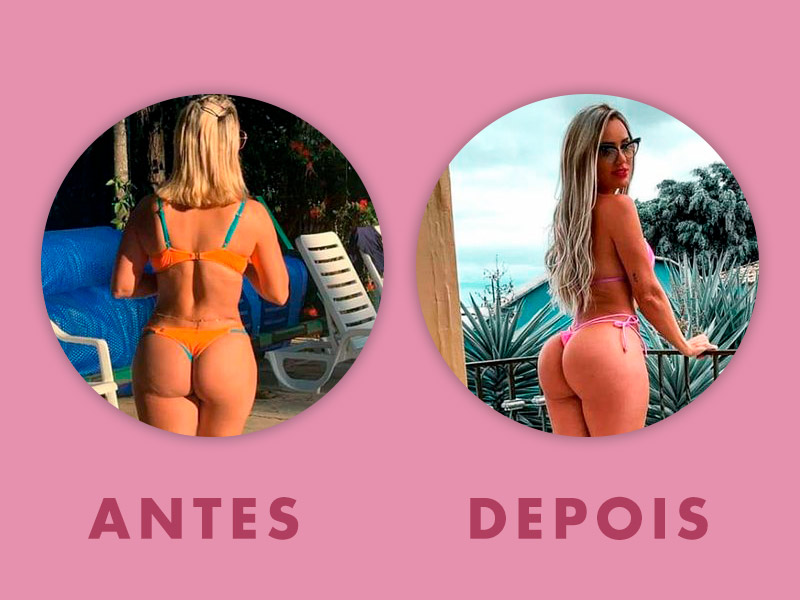 Antes e depois do PMMA nos glúteos! antes depois leticia santiago