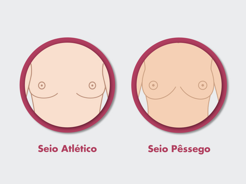 ilustração com dois dos nove tipos de seios, sendo o seio atlético e o pêssego