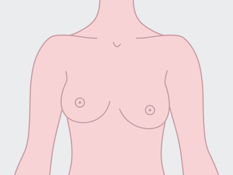 ilustração de seios com assimetria mamaria