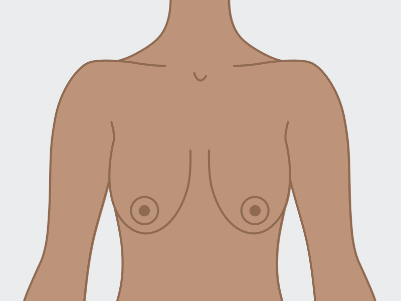 ilustração mostrando o tipo de peito caído