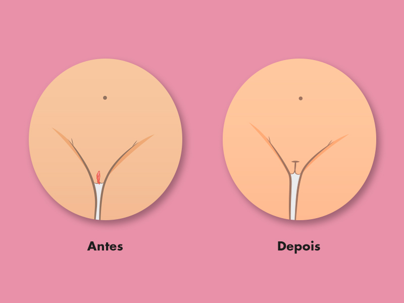 vaginoplastia antes depois