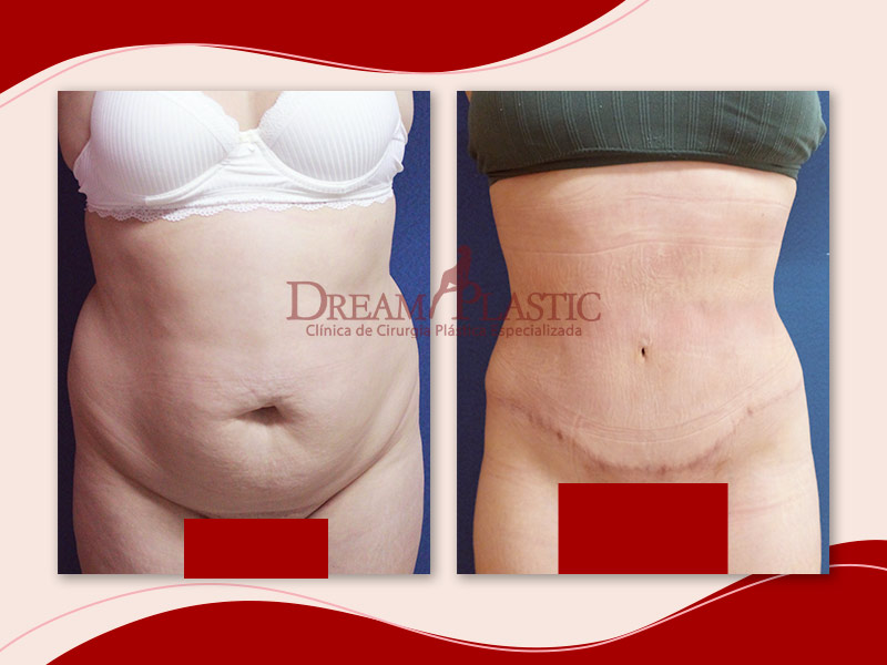 Imagem de uma paciente da Dream Plastic antes e depois da Abdominoplastia Clássica
