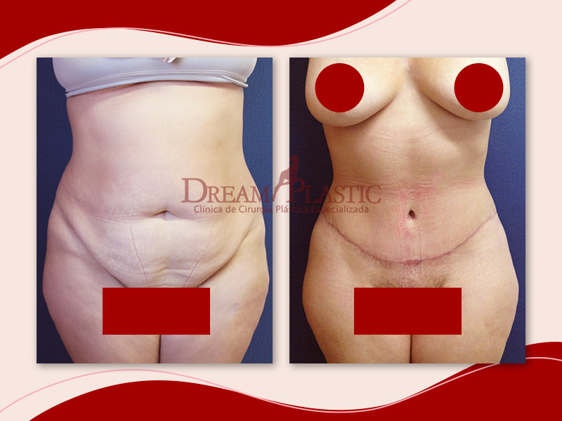 Imagem de uma paciente da Dream Plastic antes e depois da Abdominoplastia