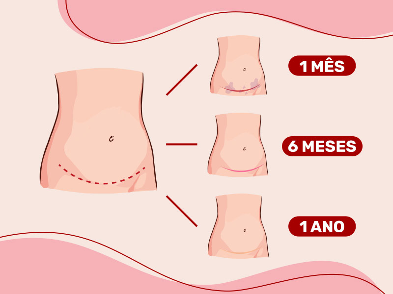 Ilustração com as fases de cicatrizes após a recuperação da abdominoplastia