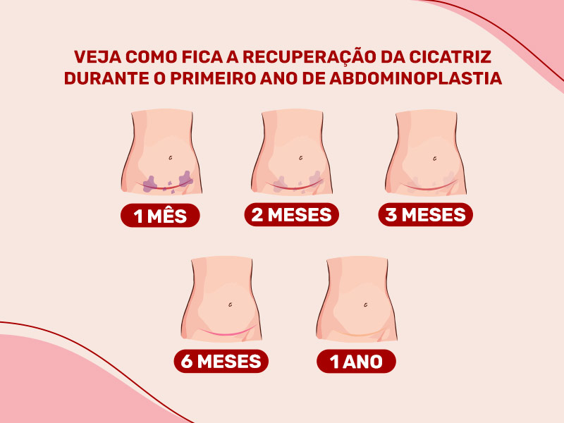 ilustração mostrando como ficaria a cicatriz da abdominoplastia ao decorrer de um ano