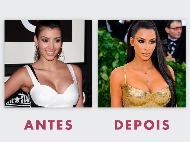 Fotos da kim kardashian antes e depois das cirurgias plásticas