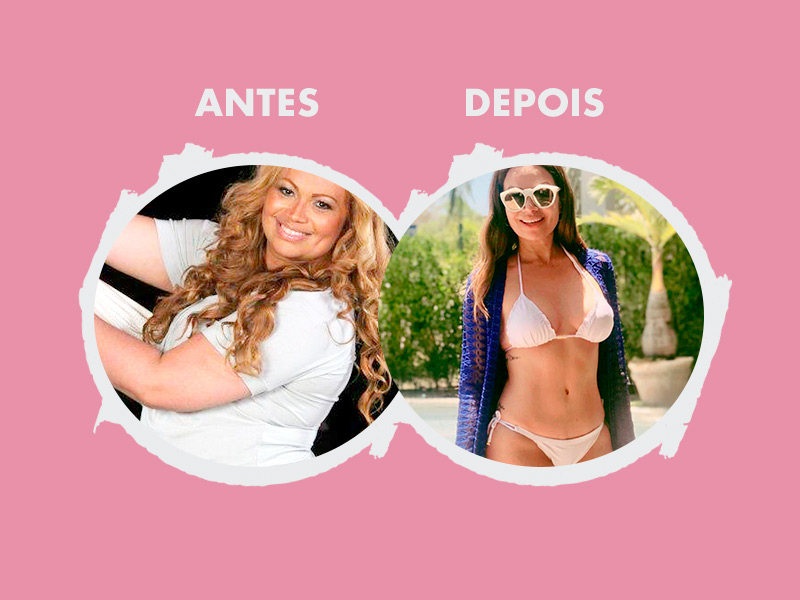 Plástica do Abdômen antes e depois de Solange Almeida plastica abdomen antes e depois