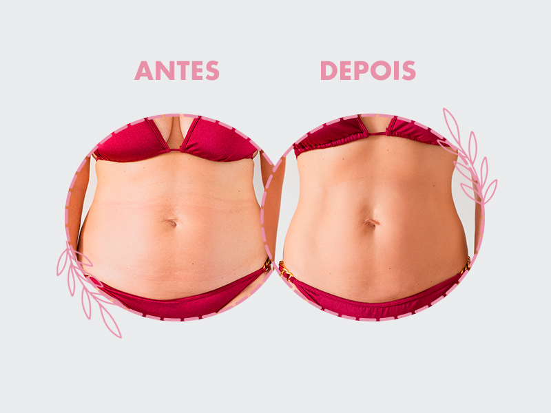 Resultados de abdominoplastia antes e depois com fotos reais. Veja onde encontrar! Resultados de Abdominoplastia antes e depois, na primeira parte está uma barriga flácida e na segunda uma barriga chapada.