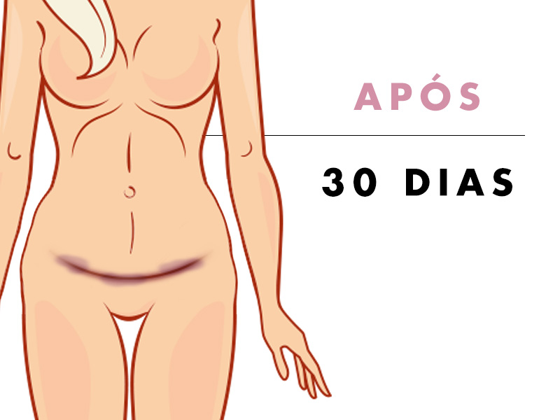 abdominoplastia depois 30 dias 