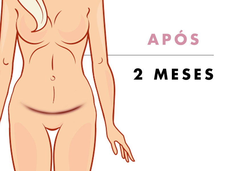 RESULTADO DA ABDOMINOPLASTIA APÓS 2 MESES fotos abdominoplastia após 2 meses onde a cicatriz permanece roxinha, mas não há tanto inchaço