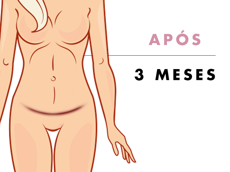 COMO FICA ABDOMINOPLASTIA 3 MESES DEPOIS abdominoplastia 3 meses depois a barriga já não tem inchaço e a cicatriz fica menos visível