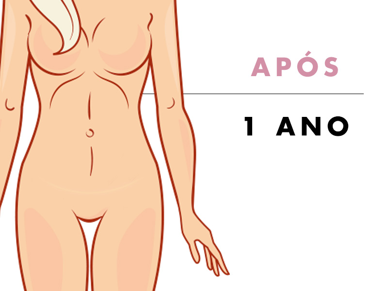Como fica a barriga de abdominoplastia depois de 1 ano 1 ano depois abdominoplastia a paciente está recuperada e a cicatriz não é visível