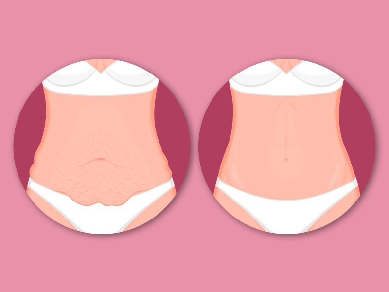 Ilustração do antes e depois da abdominoplastia, na primeira é possível ver a flacidez na barriga, já a segunda mostra uma barriga lisinha