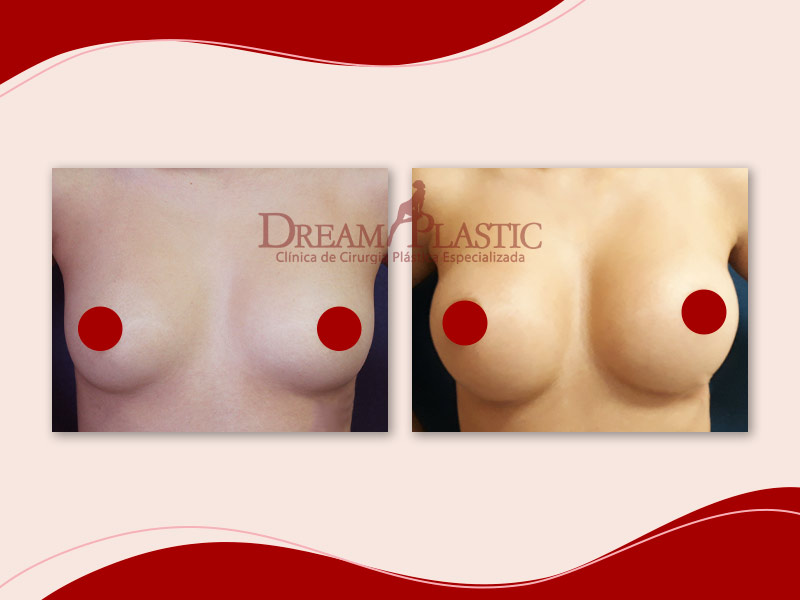 antes e depois do silicone da Raissa, paciente da Dream Plastic