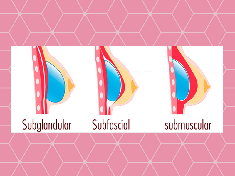 Ilustração com os tipos de colocação de silicone, subglandular, subfacial e submuscular.
