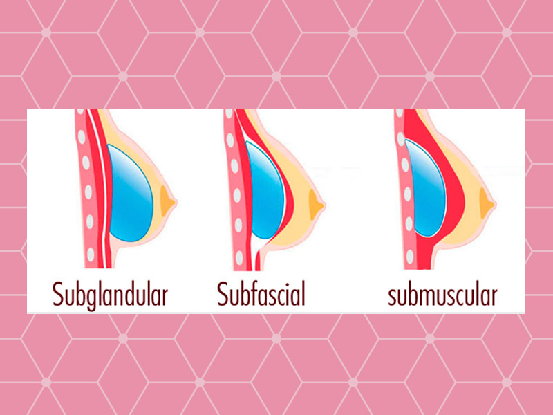 Seios com silicone antes e depois, o que devemos avaliar Ilustração com os tipos de colocação de silicone, subglandular, subfacial e submuscular.