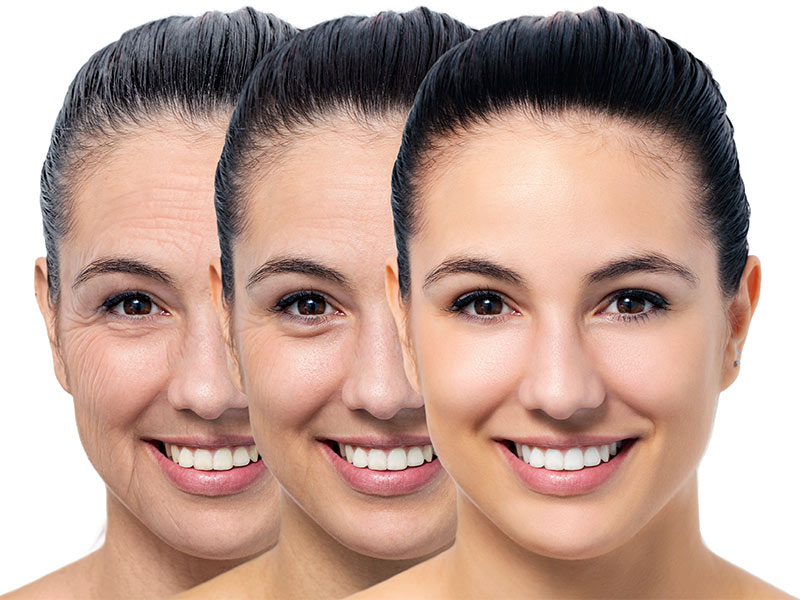 Três imagens da mesma mulher com o cabelo todo para trás, sorrindo, para mostrar o que é o rejuvenescimento facial e seus estágios