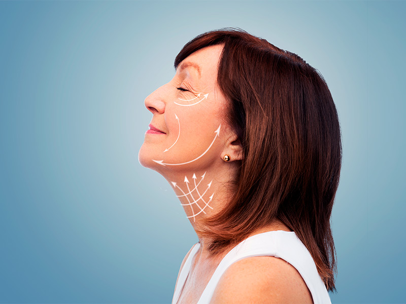 Imagem de uma mulher de lado, com setas de cor branca distribuídas entre seu pescoço e rosto, exemplificando quais são as áreas tratadas pela ritidoplastia