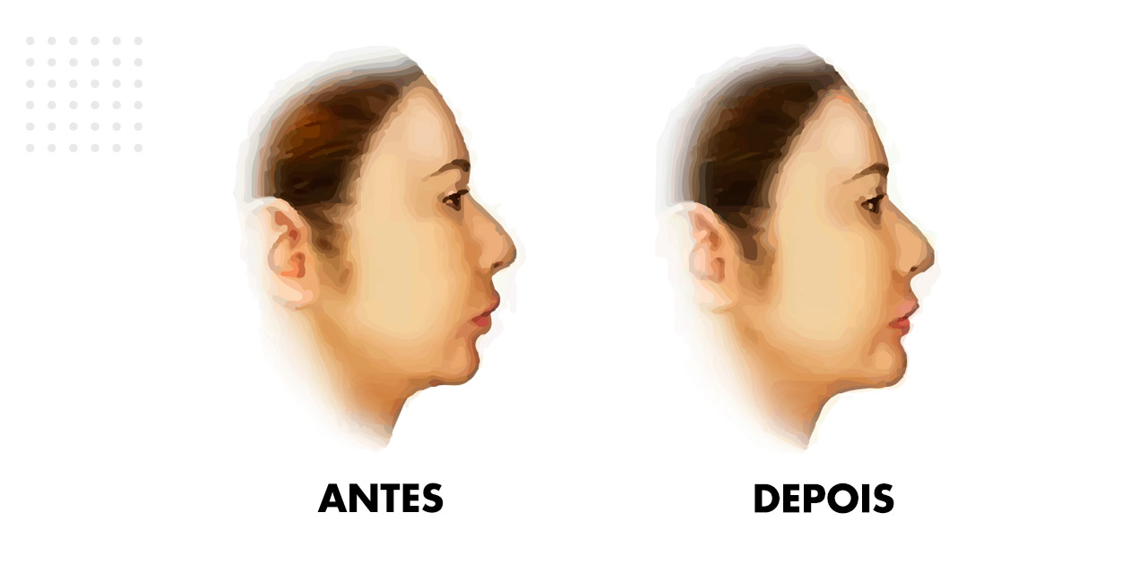 Resultados cirurgia Mentoplastia antes depois? Mentoplastia Antes e Depois