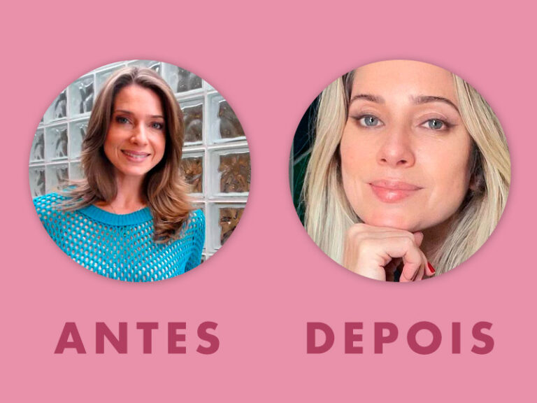 Ritidoplastia O que é, fotos de resultados e quanto custa Ritidoplastia O que é, fotos de resultados e quanto custa