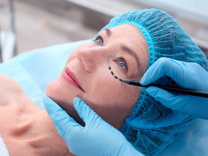 Imagem de um cirurgião realizando as marcações faciais em uma paciente que irá fazer a ritidoplastia