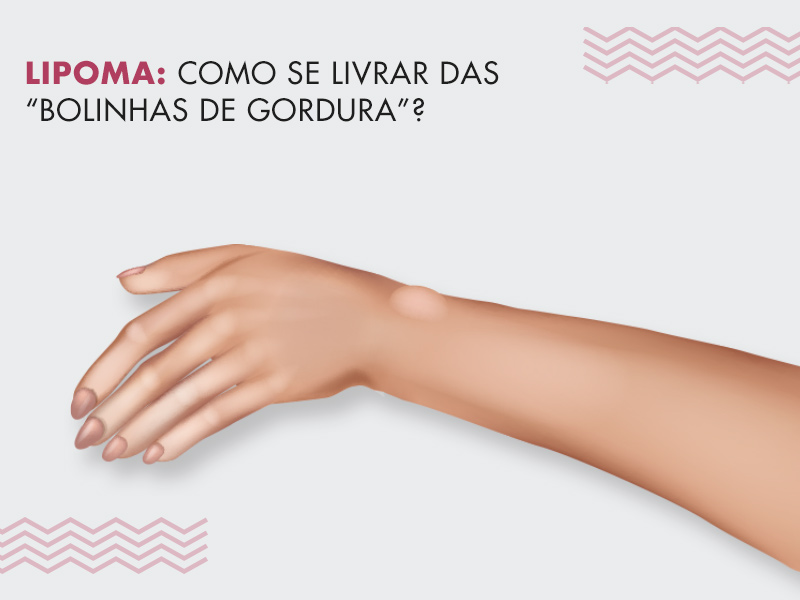 Bolinhas na pele podem ser lipomas? lipoma corpo