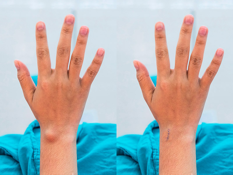 Duas fotos de lipoma nos braços, antes e depois da cirurgia
