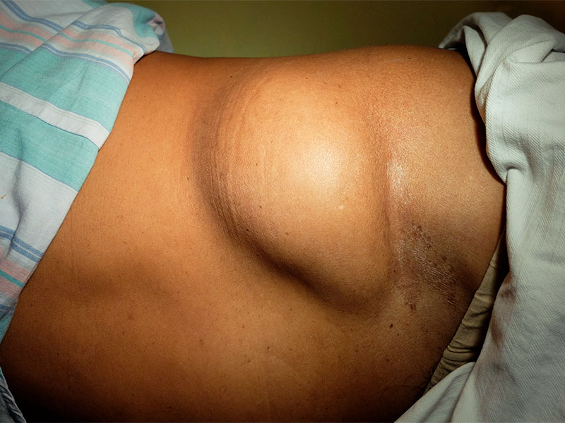 lipoma no abdômen de um paciente